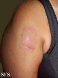 erythema annulare centrifugum