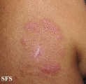 erythema annulare centrifugum