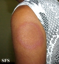 erythema annulare centrifugum