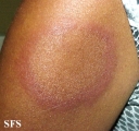 erythema annulare centrifugum