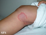erythema annulare centrifugum