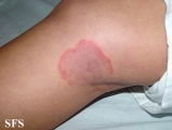 erythema annulare centrifugum