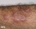 erythema annulare centrifugum