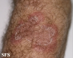 erythema annulare centrifugum