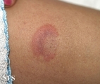 erythema annulare centrifugum