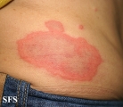 erythema annulare centrifugum