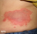 erythema annulare centrifugum