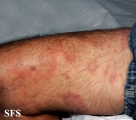 erythema annulare centrifugum