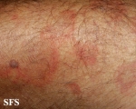 erythema annulare centrifugum