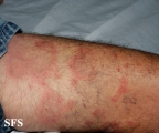 erythema annulare centrifugum
