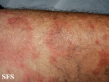 erythema annulare centrifugum