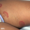 erythema annulare centrifugum