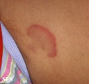 erythema annulare centrifugum