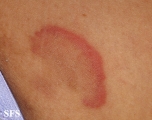 erythema annulare centrifugum