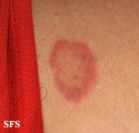 erythema annulare centrifugum