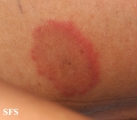 erythema annulare centrifugum