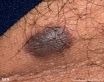 spitz_nevus-desmoplastic_spitz_nevus