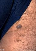 spitz_nevus-desmoplastic_spitz_nevus