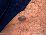 spitz_nevus-desmoplastic_spitz_nevus