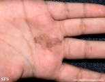 tinea nigra