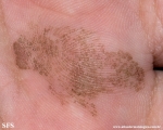 tinea nigra