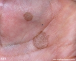 tinea nigra