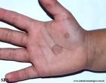 tinea nigra