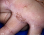 tinea nigra