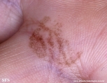 tinea nigra