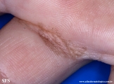 tinea nigra