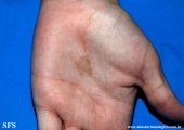 tinea nigra