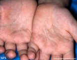 tinea nigra