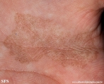 tinea nigra