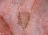 tinea nigra