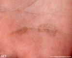 tinea nigra
