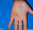 tinea nigra