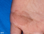 tinea nigra