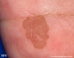 tinea nigra