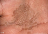 tinea nigra