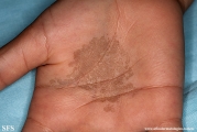 tinea nigra
