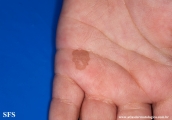 tinea nigra