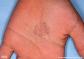 tinea nigra
