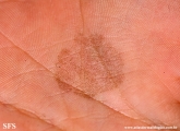 tinea nigra