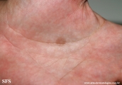 tinea nigra