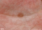 tinea nigra