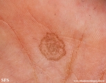 tinea nigra