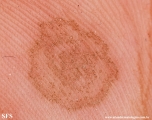 tinea nigra