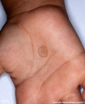 tinea nigra