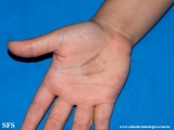 tinea nigra