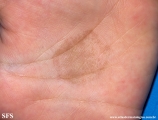 tinea nigra